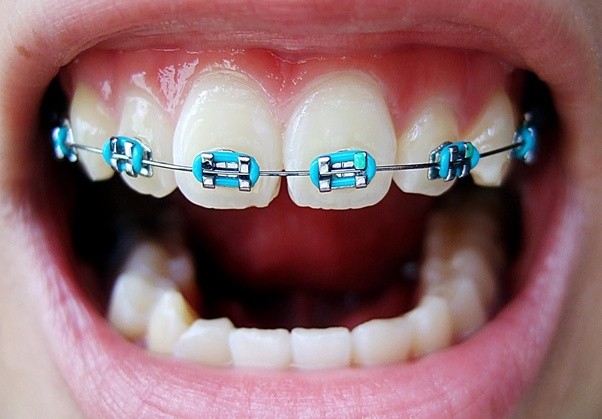 عوارض و مشکلات ارتودنسی دندان