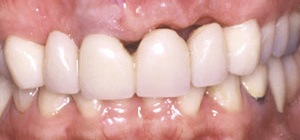 عوارض و مشکلات ارتودنسی دندان