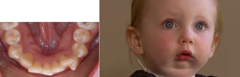 نامرتبي دندان