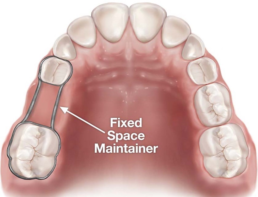 استفاده از فضا نگه‌دار برای مرتب نگه داشتن دندان‌ها تا زمان رشد دندان‌های دائمی