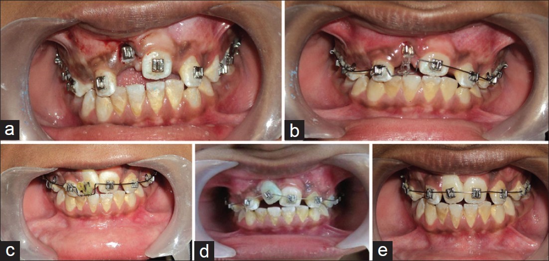 انکیلوز دندان