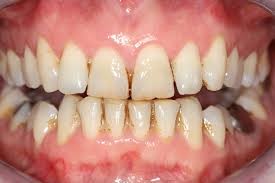 جرمگیری دندان و ارتودنسی