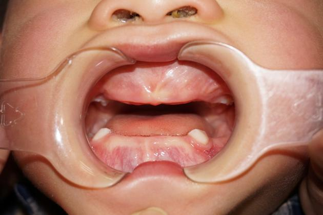 دندان درنیاوردن کودک