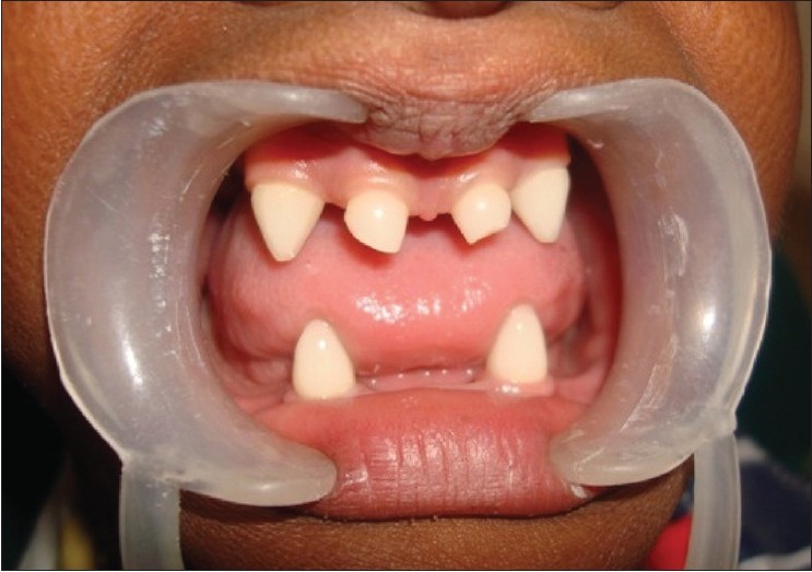 دندان درنیاوردن کودک