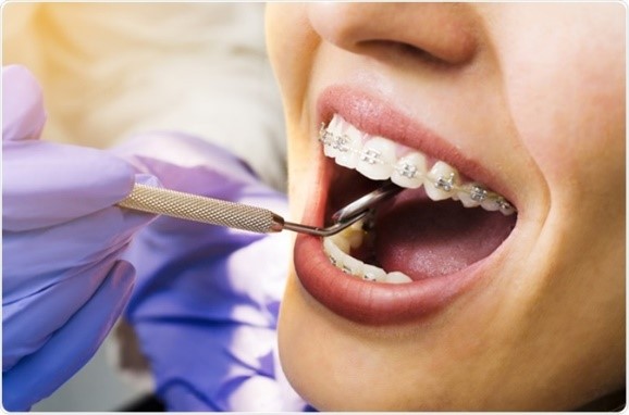 تغییر رنگ دندان ها در طول درمان ارتودنسی