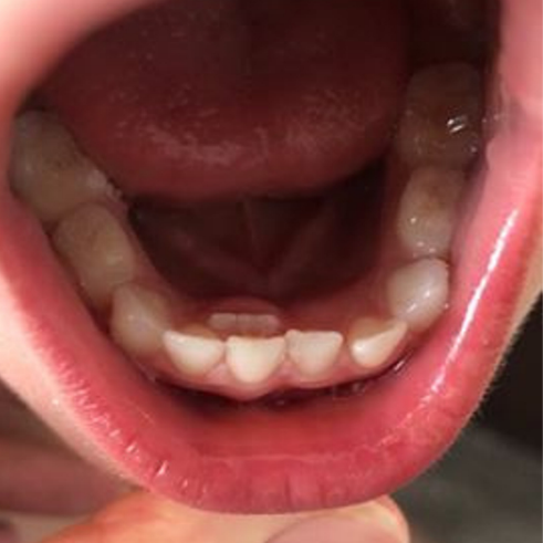 دندان کوسه ای