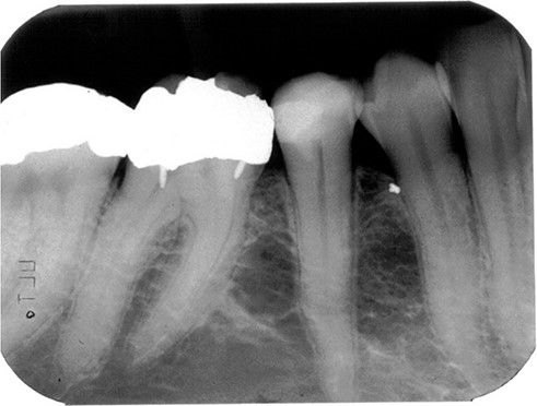 پوکی استخوان و درمان های دندانپزشکی