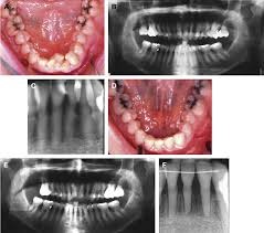 پوکی استخوان و درمان های دندانپزشکی