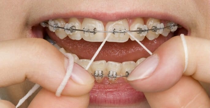 سفید کردن دندان ها پس از ارتودنسی