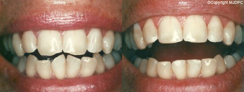 کانتورینگ یا تراش مینای دندان