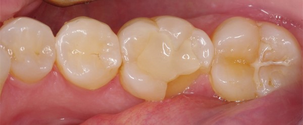 روکشهای دندانی