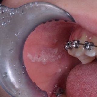 زخم دهان در طول دوره درمان ارتودنسی