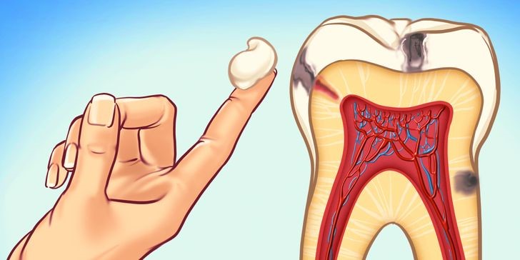 روند پوسیدگی دندان