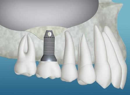 پیوند استخوان در دندانپزشکی و کاشت ایمپلنت
