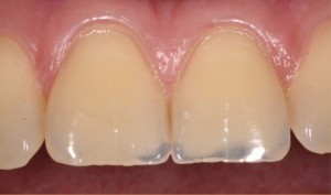 تأثیر منفی پرخوری روی دندان