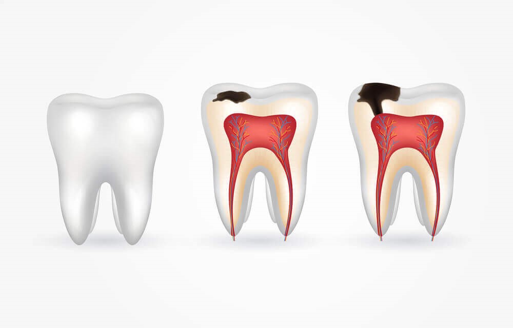تأثیر منفی پرخوری روی دندان