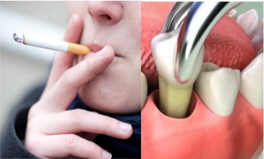 مضرات سیگار برای دهان و دندان