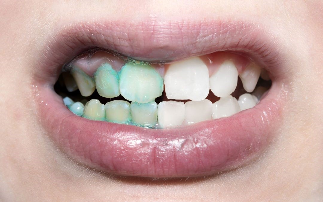 پلاک یا تارتار دندان
