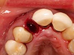 خشکی حفره دندان 
