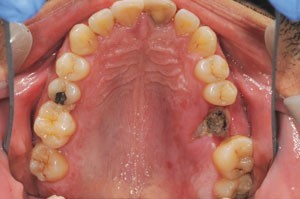 خشکی حفره دندان 