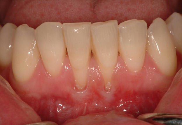 مشکلات حساسیت دندان