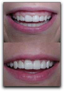 افزایش طول تاج دندان