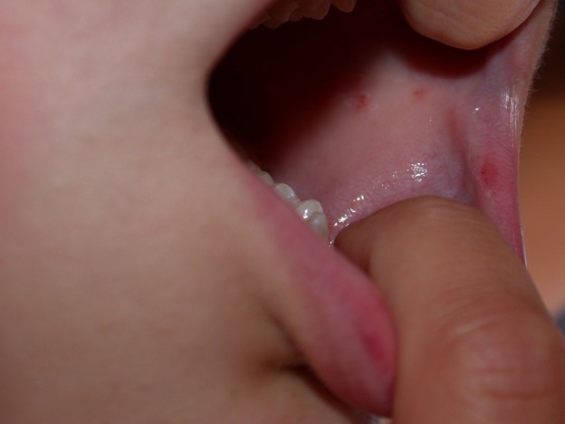 آفت دهان در کودکان