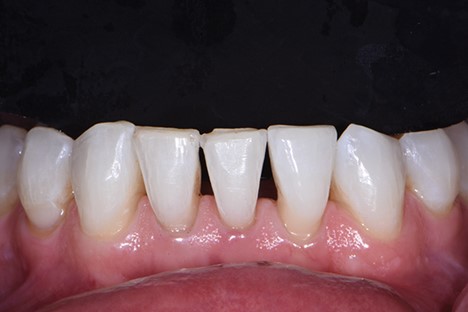 درمان مثلث سیاه بین دندان 