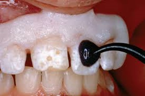 میکروابریژن مینای دندان
