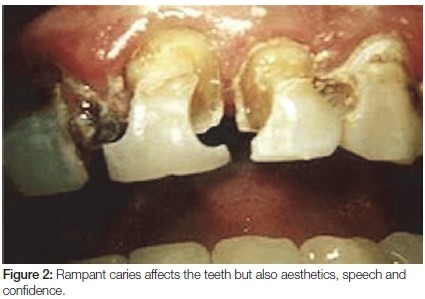 آیا پوسیدگی دندان مسری است؟