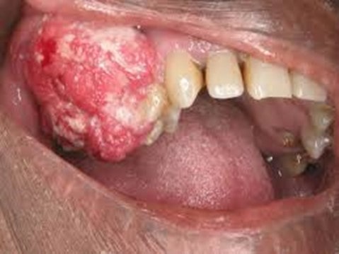 سرطان و سلامت دهان