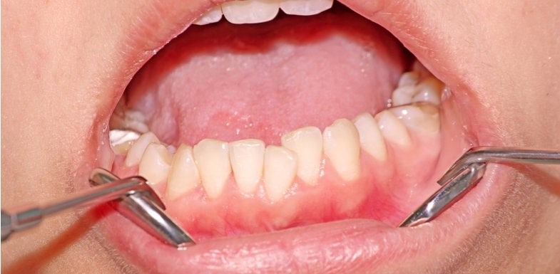علل جابجایی دندان ها