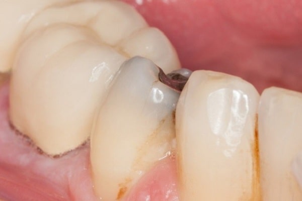 چگونه ممکن است مراقبت از دندان های شما کافی نباشد؟