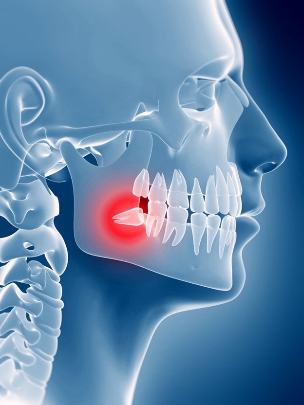 درمان های جایگزین فراتر از کشیدن دندان عقل برای بهبود خط فک